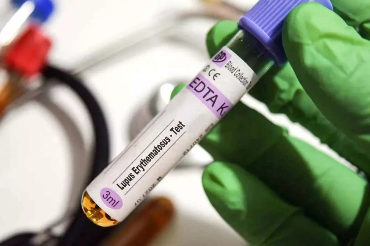 epstein-barr-virus-lupus-link_11zon