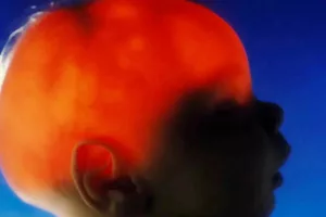 شگفتی پزشکی قرن؛ الکس سیمپسون، نوزادی که بدون مغز کامل متولد شد و امروز ۲۰ ساله است