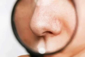 درمان فوری جوش‌های سرسیاه در خانه؛ ماسک‌های خانگی قوی و تضمینی