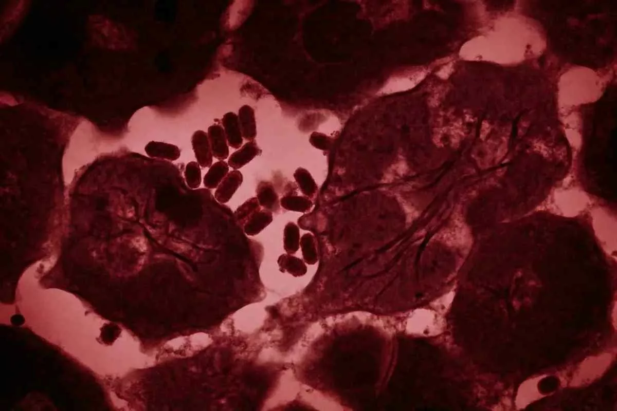 rabies-death-skunk-kidney-transplant_11zon