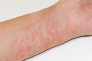 کهیر ناشی از سرما چیست؟ علائم هشداردهنده، راه‌های پیشگیری و درمان مؤثر