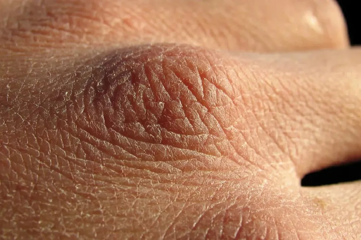 harmful-effects-of-alcohol-on-the-skin