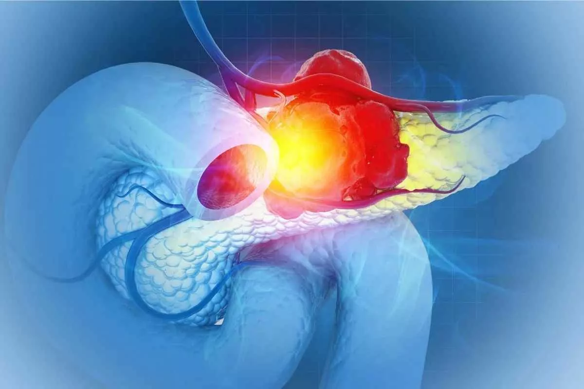 tripartite-treatment-pancreatic-cancer-cure_11zon